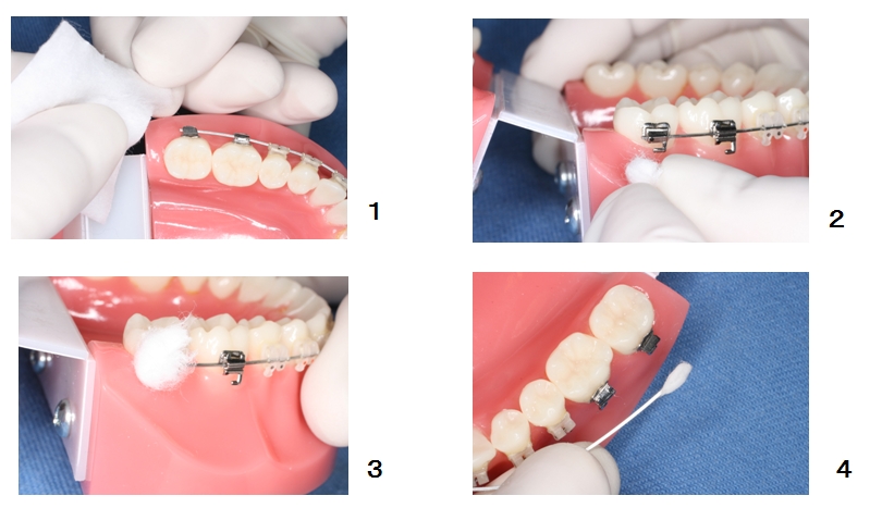 完売 歯の応急処置 前歯のカバー