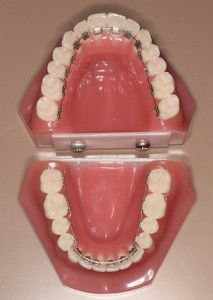 舌側装置